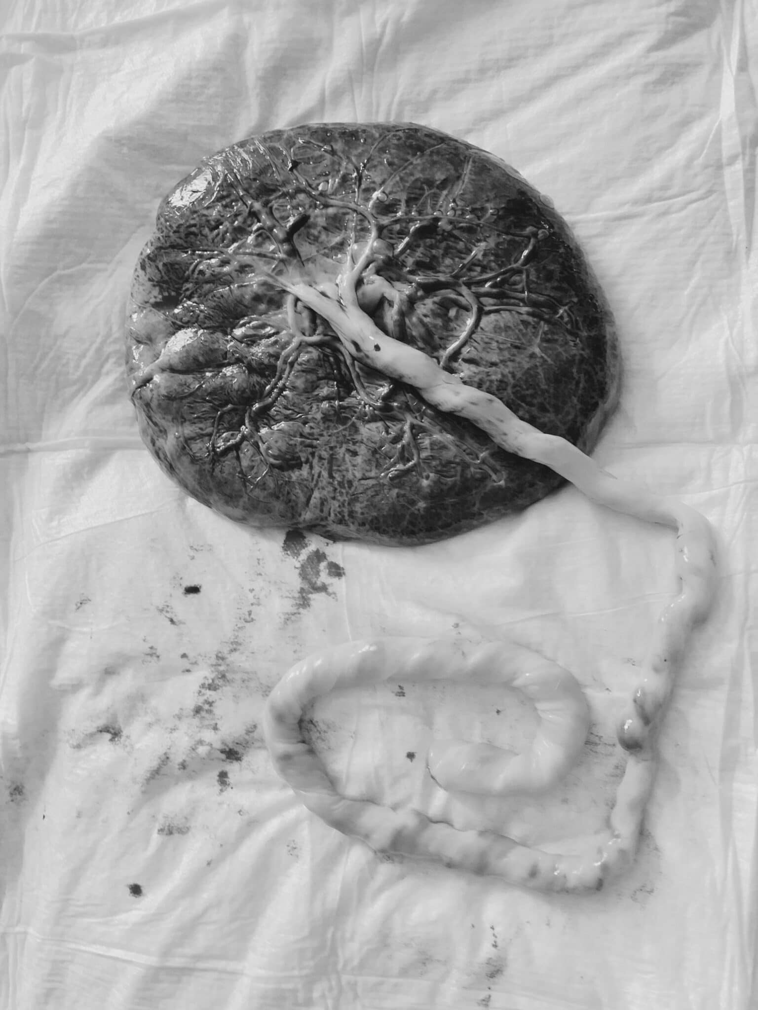 Picture of a placenta shortly after birth